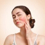 Holistic Rosacea Treatment